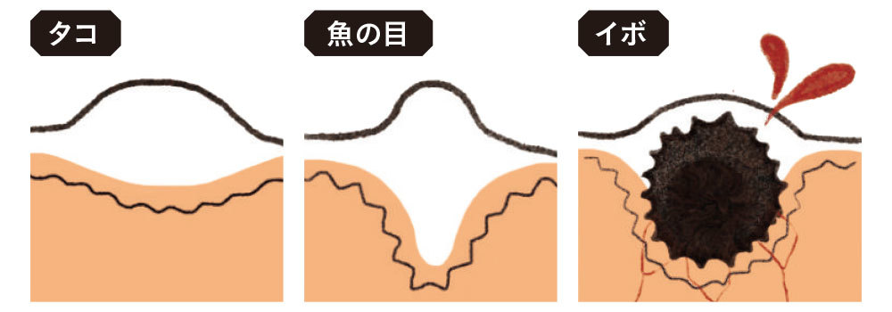 足のタコ、魚の目