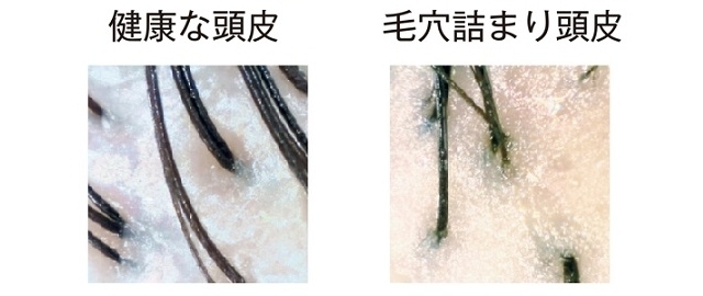 毛穴詰まり頭皮と健康な頭皮