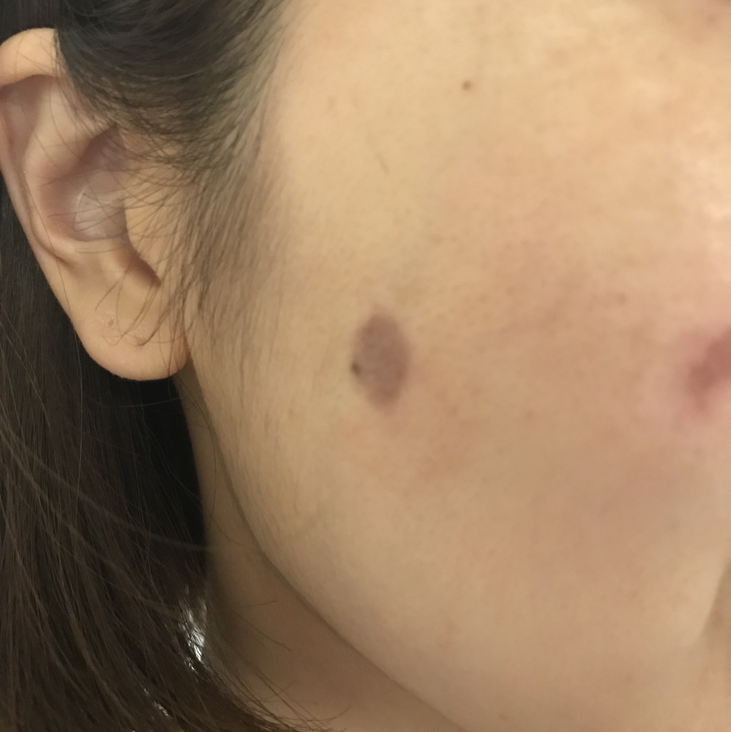 シミのお悩み解決 アラフォー的美容医療への挑戦 ファッション誌marisol マリソル Online 40代をもっとキレイに 女っぷり上々