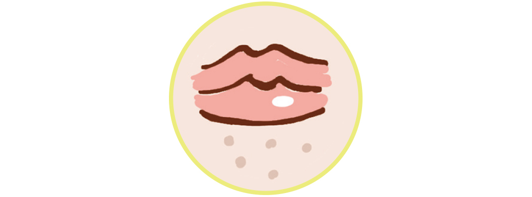 詰まり毛穴