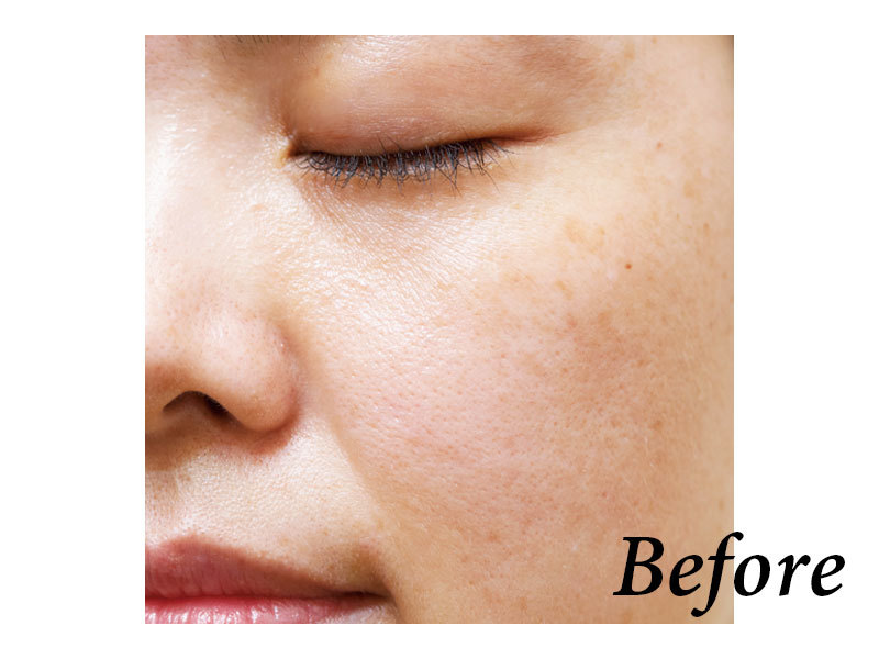 ダウンタイムのないエステ感覚で毛穴悩みを解消 本当は怖くない美容医療 ファッション誌marisol マリソル Online 40代をもっとキレイに 女っぷり上々