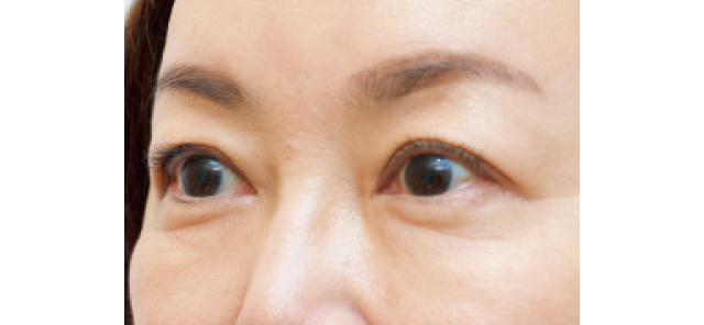 目もとハイフシャワーの施術前の様子
