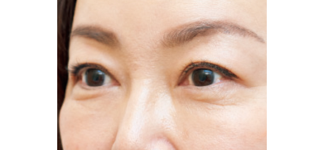目もとハイフシャワーの施術後の様子