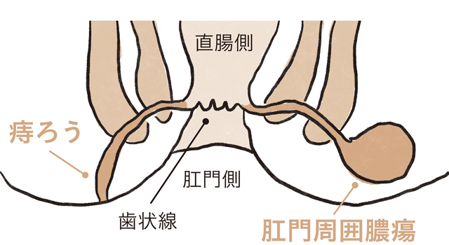 痔ろう(あな痔)