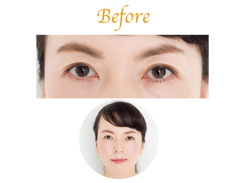 くっきり二重さんのbefore写真