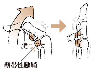 1. 指を伸ばすとばねのように戻る “ばね指”【50代のお悩み・更年期の手指問題】_1_1