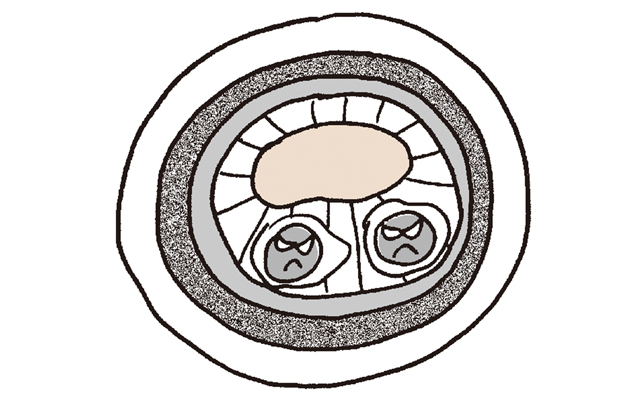 動脈硬化のすすみ方3