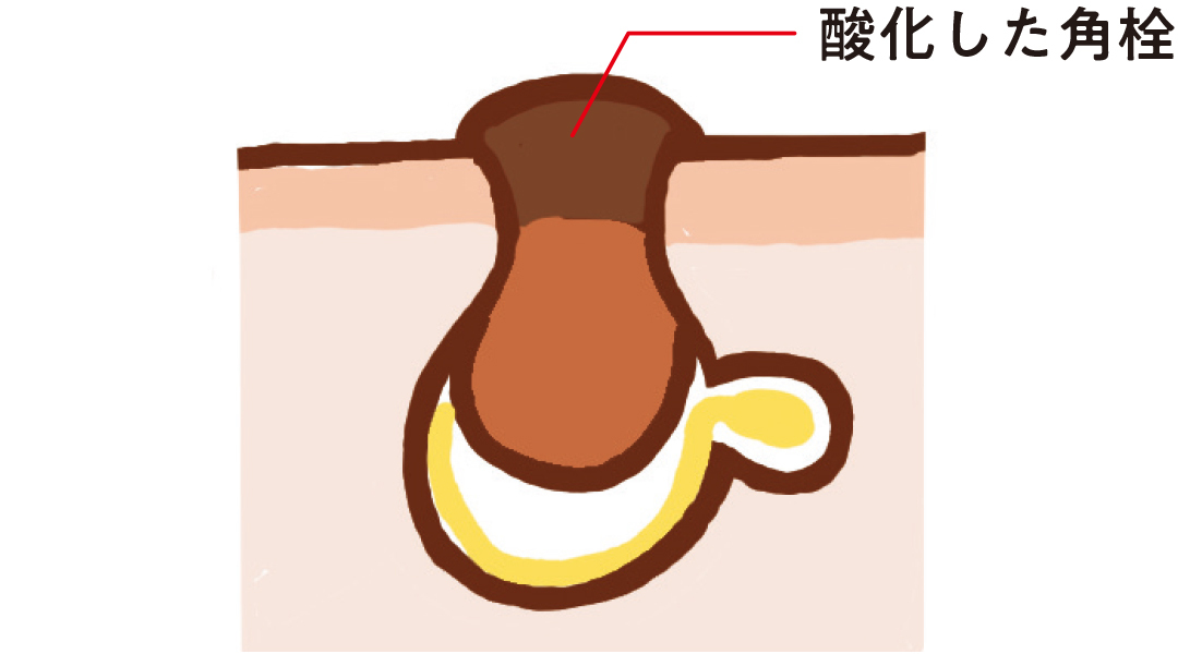 黒ずみ毛穴の状態