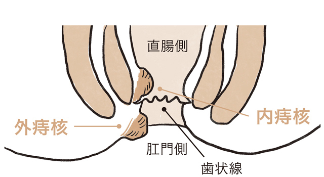 痔核(いぼ痔)