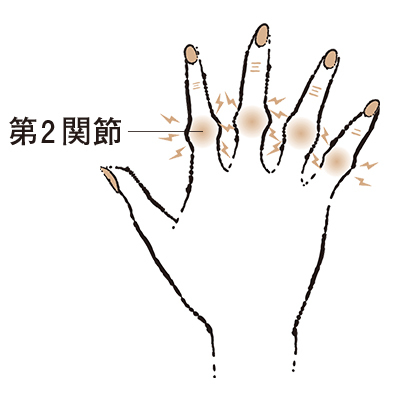 5. 第2関節がこぶ状に膨らむ “ブシャール結節”【50代のお悩み・更年期の手指問題】_1_1