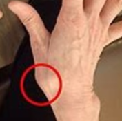 『母指CM関節症』が進んだ状態。ゴツゴツとした見た目に。