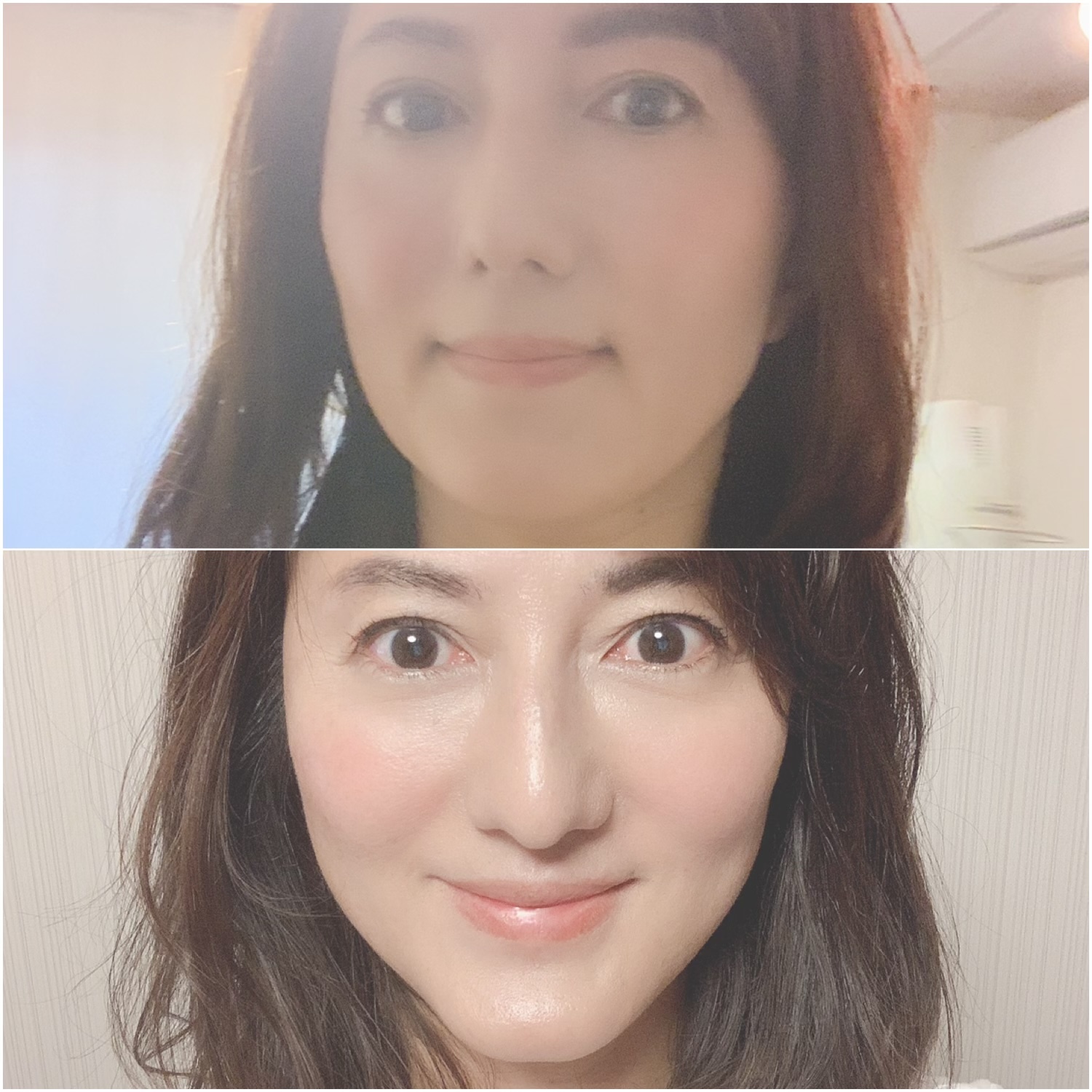 美容針で小顔に Web Eclat 50代女性のためのファッション ビューティ ライフスタイル最新情報